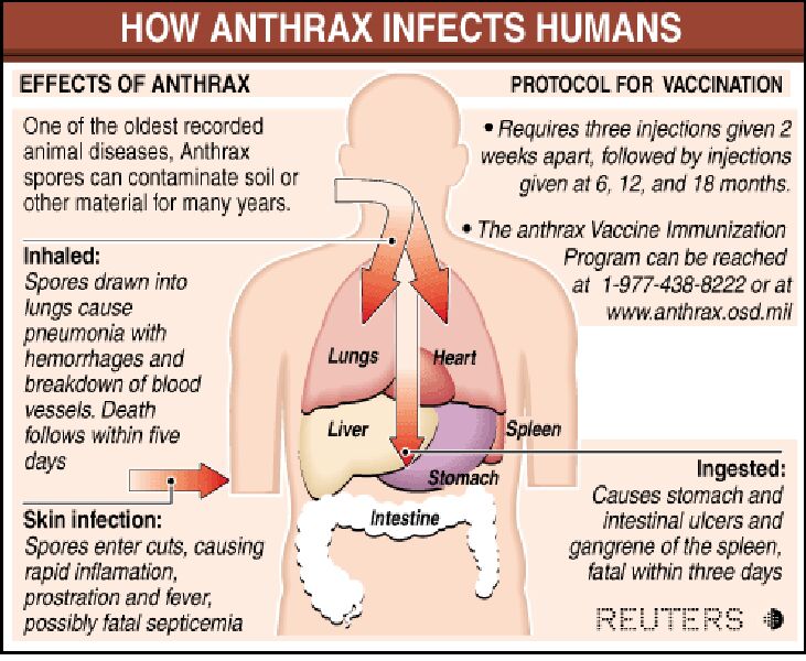 anthrax symptoms